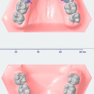 Indirektes Kleben 3d Druck