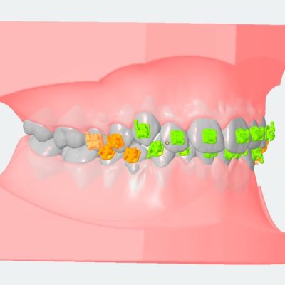 Indirektes Kleben 3d Druck Platzierte Brackets